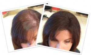 Before and After Volluma